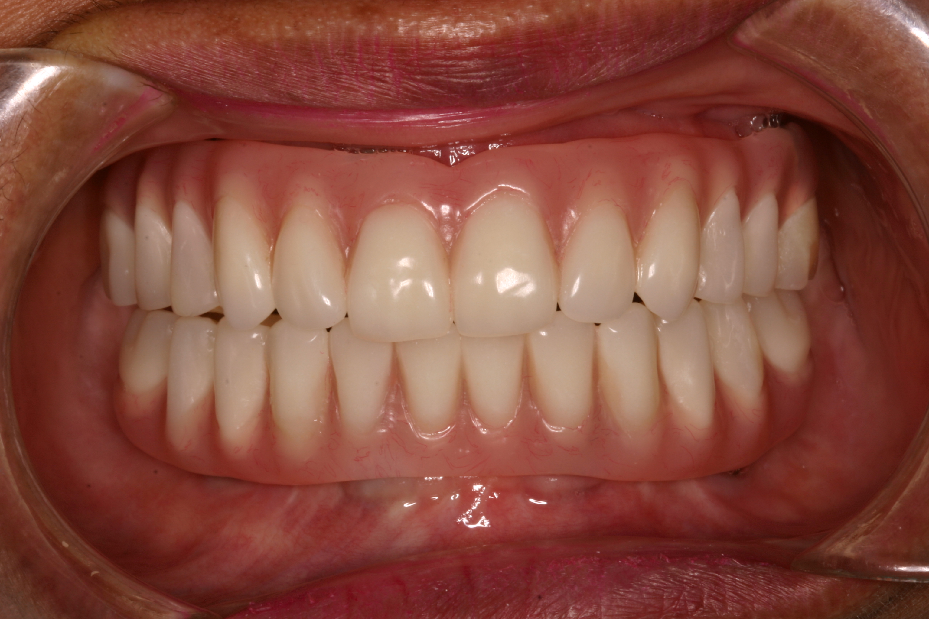 Dental Implants in Honolulu Hawaii Implant Dentist